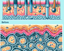 Einfluss von Testosteron undecanoat auf die Haut bei Steroidanwendern: Dermatologische Perspektive